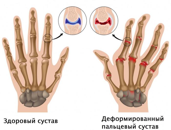 Сравнение суставов здорового и больного человека